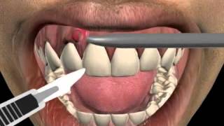 How to treat a tooth abscess [upl. by Sucramd]