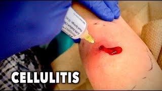 ABSCESS WITH CELLULITIS We had to drain it  Dr Paul [upl. by Phillipe]