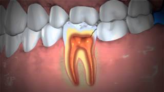 Treatment of Abscessed Teeth [upl. by Georgiana429]