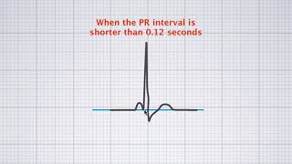 Interpreting ECG duration [upl. by Elleinad]