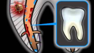 Root Canal Treatment Complications  Risks [upl. by Erleena]