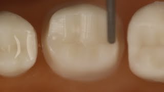 PFM Crown Posterior Tooth Preparation With Metal Occlusal [upl. by Albrecht]