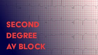 Second Degree Heart Block  Electrocardiogram ECGEKG Interpretation [upl. by Merari924]