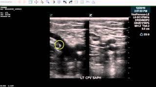 Positive LE DVT Exam  Case Study [upl. by Beltran110]