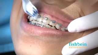 Corrective Jaw Orthognathic Surgery Animation [upl. by Drareg599]