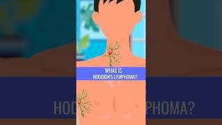 What is HODGKINS LYMPHOMA [upl. by Hgiellek578]