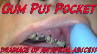 a pus pocket in the gum [upl. by Denna]