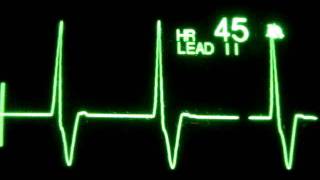 Accelerated Ventricular Rhythm AVR [upl. by Notlim449]