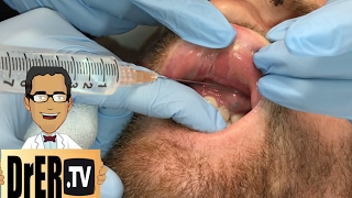 gum abscess drainage  Full VIDEO [upl. by Ggerg]