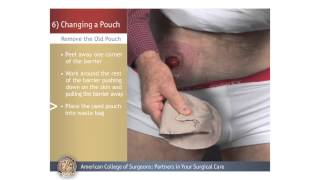 ColostomyIleostomy Changing a Pouch [upl. by Maddie]