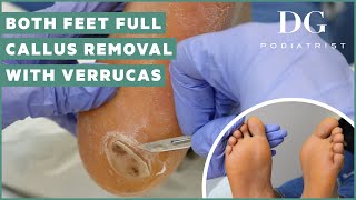 Callus removal from feet both feet and three verruca plantar warts treatment [upl. by Mariko]