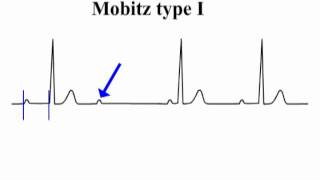 ECG Interpretation  AtrioVentricular Block [upl. by Iddet]