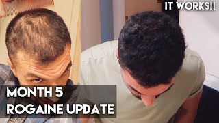 5 Month Rogaine Update Minoxidil  IT WORKS [upl. by James]