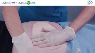 AQUACEL® Foam Application  Sacral Pressure Ulcer [upl. by Celestyn872]