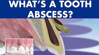 TOOTH ABSCESS dental infection  PHLEGMON symptoms and treatment © [upl. by Chevy123]