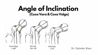 Lower limb exercise of a coxa vara suffering patient [upl. by Nohtanoj]