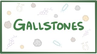 Gallstones cholelithiasis [upl. by Handal]