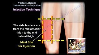 Clinical Correlation  Varus and Valgus and the Physical Exam CORRECTED [upl. by Ttegirb]