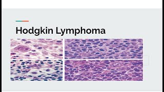 Hodgkin lymphoma [upl. by Adnauqahs936]