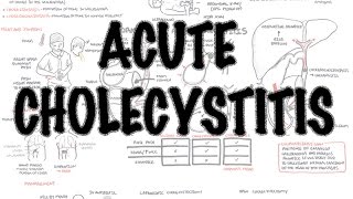 Acute Cholecystitis  Overview signs and symptoms pathophysiology treatment [upl. by Eceinal]