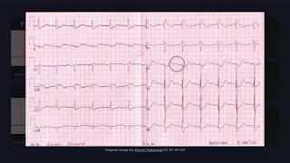 First Degree Atrioventricular Block ECG [upl. by Ecnerrat485]