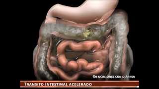 sindrome de intestino irritable [upl. by Ernald]