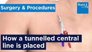 How a tunnelled central line is placed  Bupa Health [upl. by Yahsal]