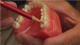 Tooth amp Gum Abscesses  How Dentists Drain an Abscessed Tooth [upl. by Jamaal53]