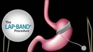 Fast Facts about The LAPBAND® procedure [upl. by Iliam]