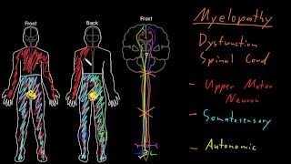 Syndrome Myelopathy [upl. by Asilanom]