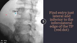 Epidural Steroid InjectionPatient Education Video [upl. by Bodi]