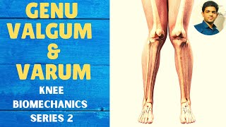 GENU VALGUM amp GENU VARUM  Knee Complex Biomechanics [upl. by Jorrie428]