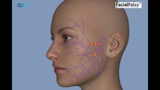 Understanding Facial Palsy [upl. by Blayze529]