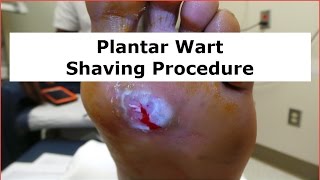 Plantar Wart Shaving Procedure [upl. by Eiznikcm262]