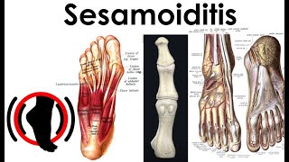 Sesamoiditis  Treatment Complications [upl. by Brezin]